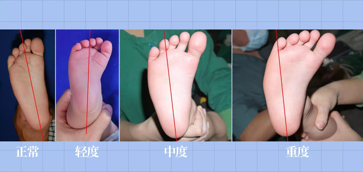 足底壓力分布計量